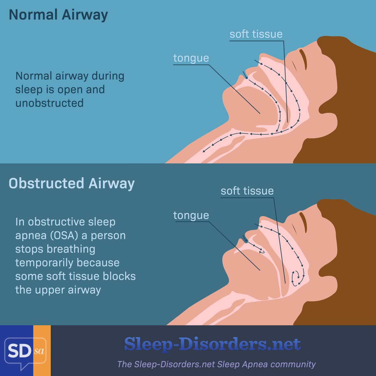 diagram showing how obstructive sleep apnea occurs when soft tissue blocks the upper airway